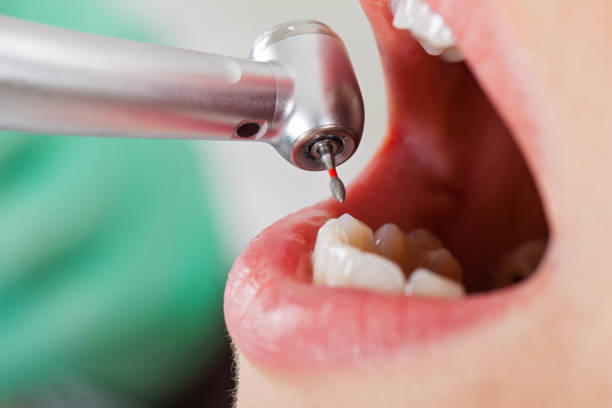 Best Emergency Tooth Extraction in Walled Lake, MI